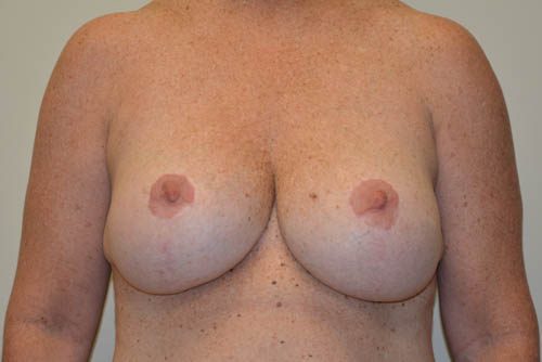 Breast Implant Removal Before Patient 1