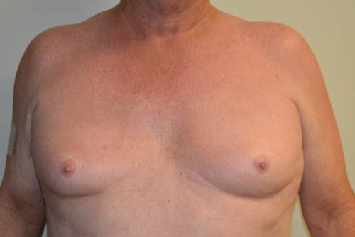 Male Breast Reduction Before Patient 1