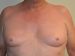 Male Breast Reduction Before Patient Thumbnail 1