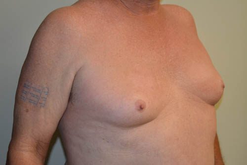 Male Breast Reduction Before Patient 4