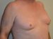 Male Breast Reduction Before Patient Thumbnail 4