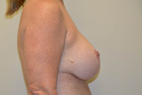 Breast Implant Removal Before Patient 5