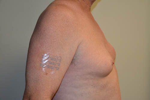 Male Breast Reduction Before Patient 5
