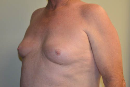 Male Breast Reduction Before Patient 2