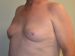 Male Breast Reduction Before Patient Thumbnail 2