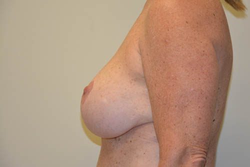 Breast Implant Removal Before Patient 3