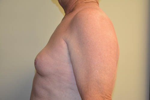 Male Breast Reduction Before Patient 3