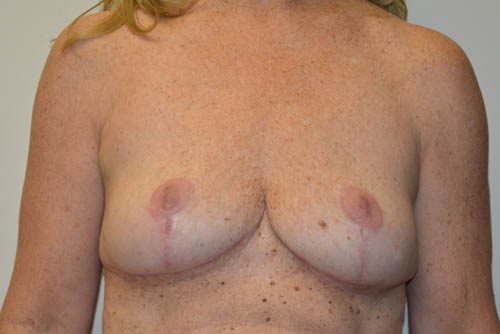 Breast Implant Removal After Patient 1