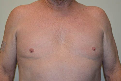 Male Breast Reduction After Patient 1