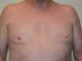 Male Breast Reduction After Patient Thumbnail 1