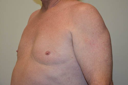 Male Breast Reduction After Patient 2