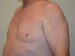 Male Breast Reduction After Patient Thumbnail 2