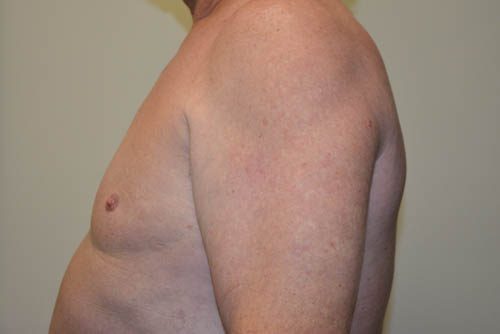 Male Breast Reduction After Patient 3