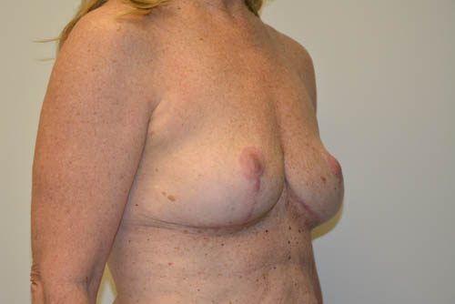 Breast Implant Removal After Patient 4