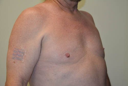 Male Breast Reduction After Patient 4