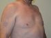Male Breast Reduction After Patient Thumbnail 4