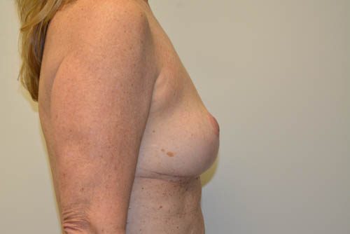 Breast Implant Removal After Patient 5