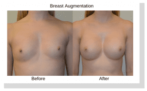 Breast Augmentation Before and After