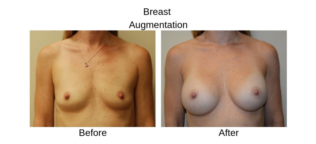 Before and After Breast Augmentatin