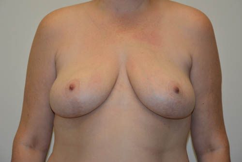 Breast Lift After Patient 1