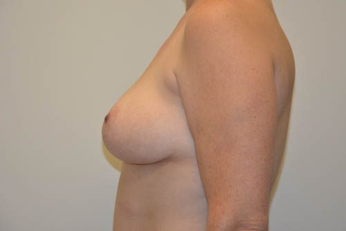 Breast Lift After Patient 3