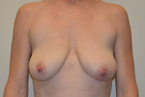 Breast Lift Before Patient 1