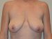 Breast Lift Before Patient Thumbnail 1