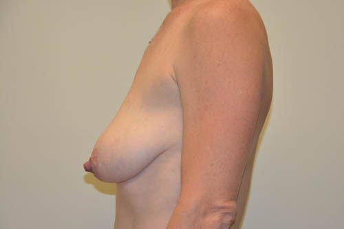 Breast Lift Before Patient 5