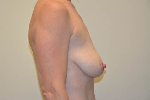 Breast Lift Before Patient 3