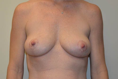 Breast Lift After Patient 1