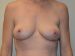 Breast Lift After Patient Thumbnail 1