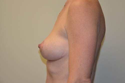 Breast Lift After Patient 5