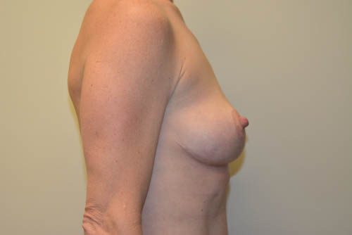 Breast Lift After Patient 3