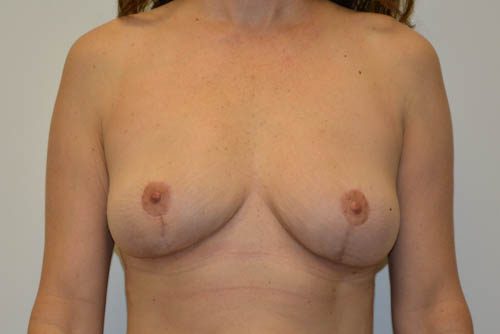 Breast Implant Removal After Patient 1