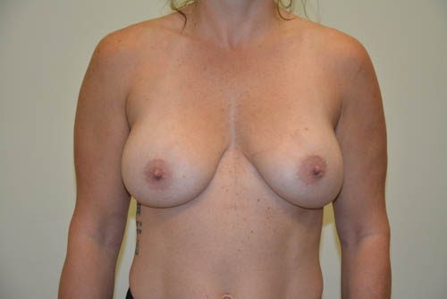 Breast Implant Removal Before Patient 1