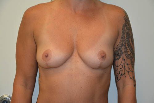 Breast Implant Removal After Patient 1