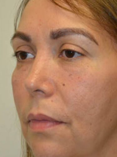 Injectable Fillers After Patient 2