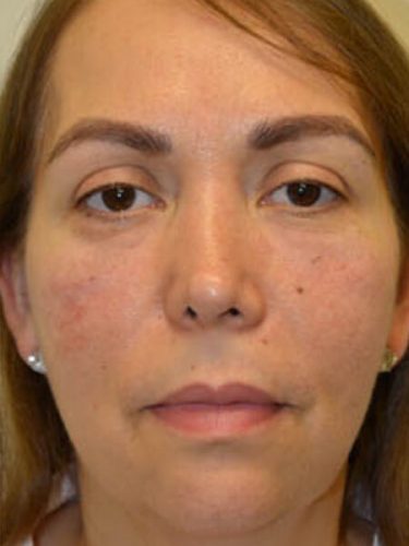 Injectable Fillers After Patient 1