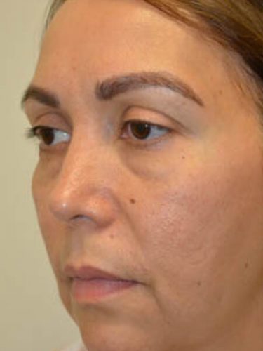 Injectable Fillers Before Patient 2