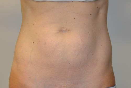 Mini Tummy Tuck Before Patient 1