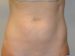 Mini Tummy Tuck Before Patient Thumbnail 1