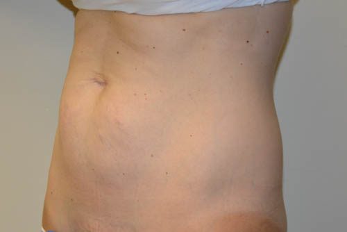 Mini Tummy Tuck Before Patient 2