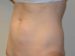 Mini Tummy Tuck Before Patient Thumbnail 2