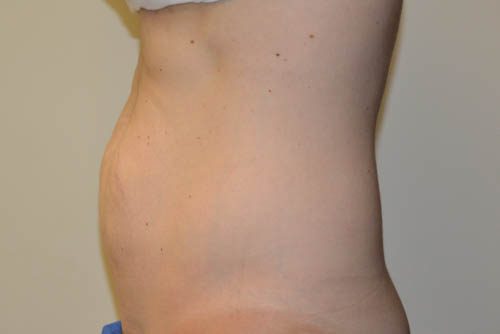 Mini Tummy Tuck Before Patient 3