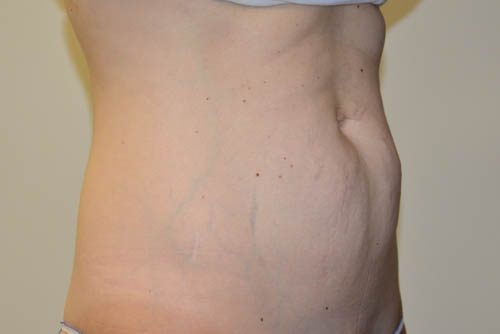 Mini Tummy Tuck Before Patient 4