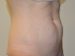 Mini Tummy Tuck Before Patient Thumbnail 4