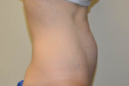 Mini Tummy Tuck Before Patient 5