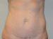 Mini Tummy Tuck After Patient Thumbnail 1