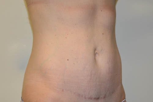 Mini Tummy Tuck After Patient 4