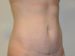 Mini Tummy Tuck After Patient Thumbnail 4